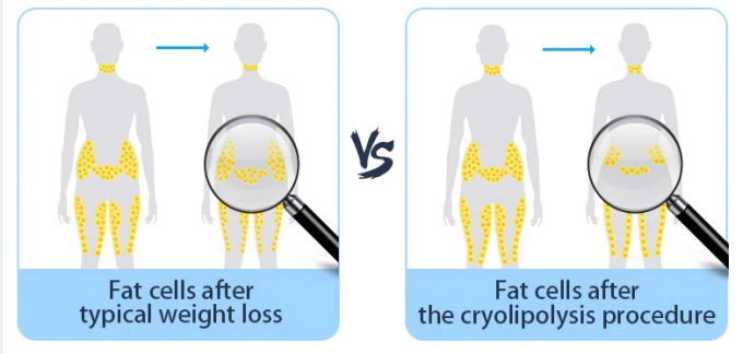 機械円周およびセルライトの減少を細くするクリオリポリシスの脂肪質の氷結